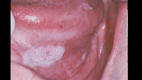 Human Papillomavirus And Oral Cancer Perio Implant Advisory