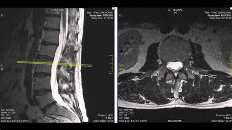 Normal Lumbar Spine MRI Explained Dr Jeffrey P Johnson HD YouTube