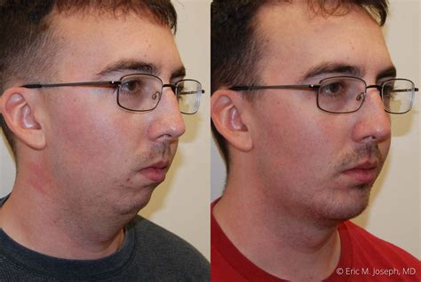 Eric M Joseph Md Chin And Neck Before And After Chin Implant With Neck