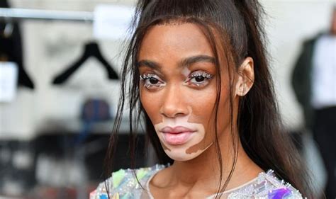 Winnie Harlow Vitiligo What Is The Skin Condition Symptoms And Signs