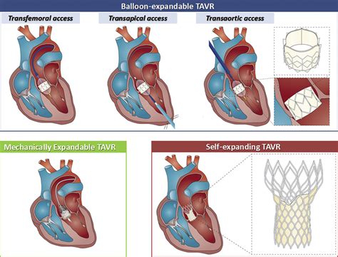 Transcatheter Aortic Valve Replacement Cardiology Clinics
