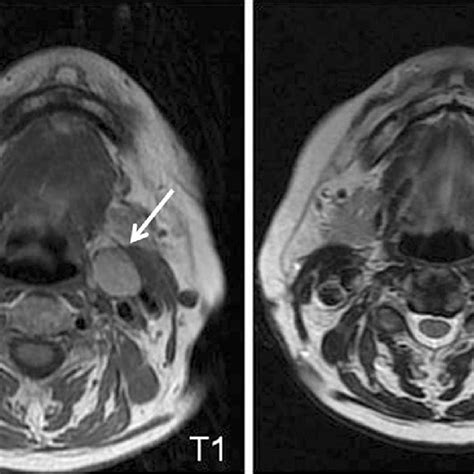 Pdf Accuracy Of Mri For The Diagnosis Of Metastatic Cervical