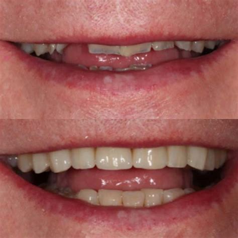 dental bridges charleston sc tooth bridge smith custom dentistry