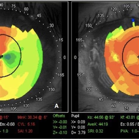 Corneal Topography Changes Before And After Recurrent Pterygium