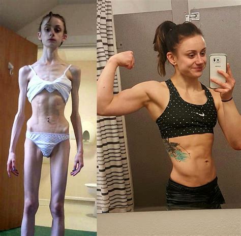 Before And After Anorexia Reddit Pics Pinterest Anorexia