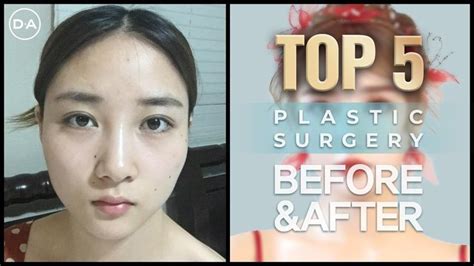 Da Top 5 Before And After Plastic Surgery In Korea