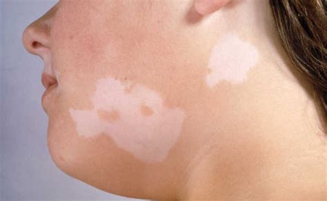 Vitiligo Causes Symptoms And Treatment Health Care Qsota