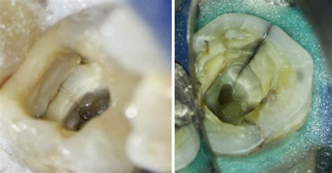 Endodontic Armamentarium Pocket Dentistry