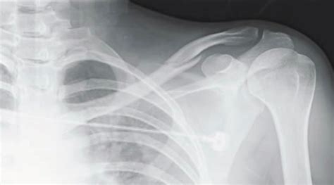 Clavicle Fracture Xray
