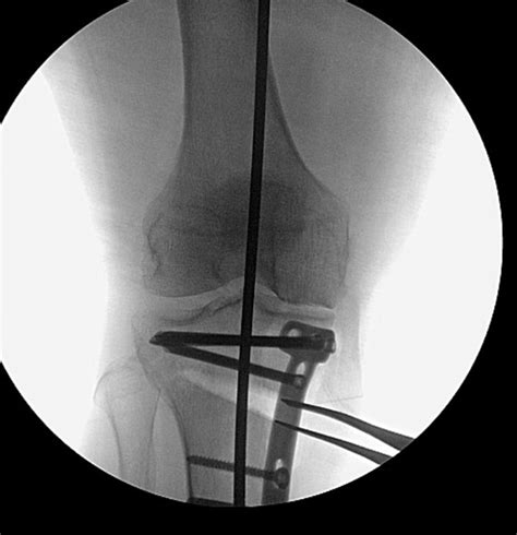 Knee Realignment And Joint Preservation Prox Tibial Osteotomy