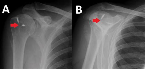 Cureus A Rare Case Of Rotator Cuff Interposition Causing Humeral Head