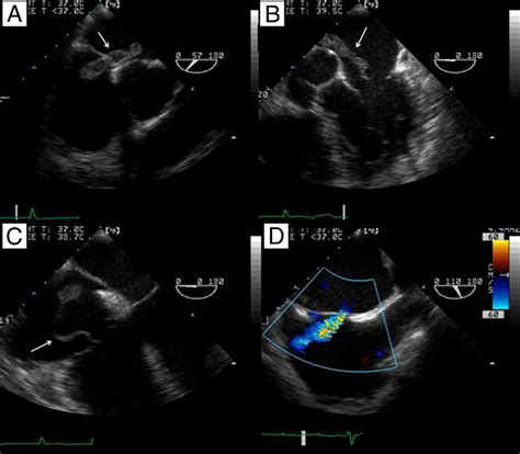 Paradoxical Embolism Via An Atrial Septal Defect In Flagrante Delicto