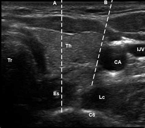 Ultrasound Imaging Of The Left Stellate Ganglion A The Needle Path