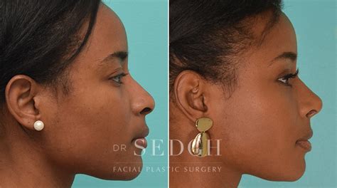 Black Rhinoplasty Before And After
