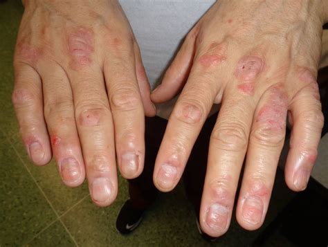 Psoriasis On Knuckles