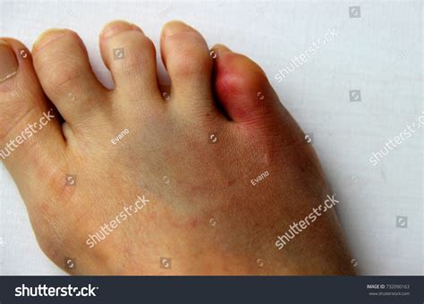 Bruised Foot Fractured Toe Stock Photo 732090163 Shutterstock