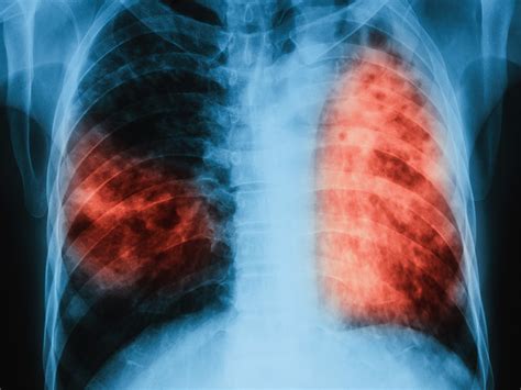Tb) is a species of pathogenic bacteria in the family mycobacteriaceae and the causative agent of tuberculosis. Penyakit Yang Disebabkan Oleh Bakteri Mycobacterium ...
