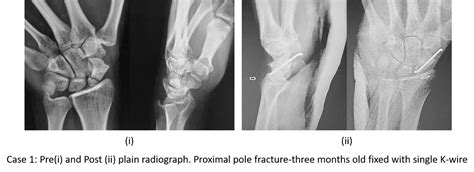 An Innovative Technique Axial Loading And Compression Fixation Alcf