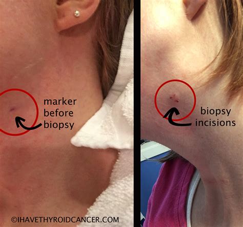 Biopsy To Check For Thyroid Cancer In Lymph Node