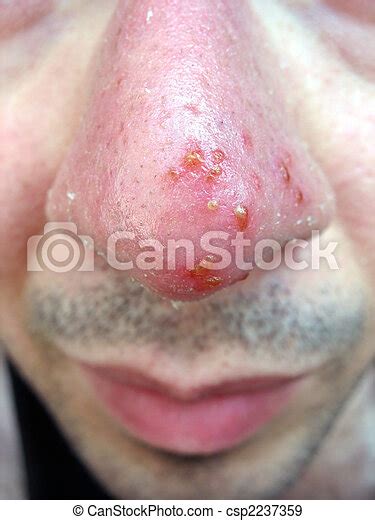Nose Cold Sore A Medical Condition Closeup Of The Common Coldsore