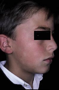 1,2 lesions present on the face, upper body and limbs, 1,2, 19 and may progress through three stages: Bases diagnósticas de las enfermedades cutáneas