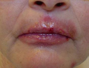 The herpes virus and your body will. Mouth Herpes - Pictures, Symptoms and Treatment