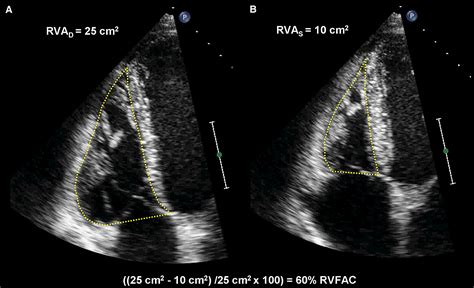 Assessment Of The Right Ventricle By Echocardiography A Primer For