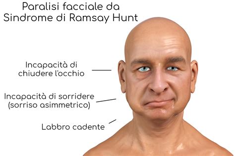 Sindrome Di Ramsay Hunt Herpes Zoster Oticus Cause Sintomi Pericoli