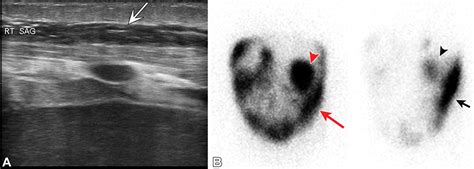 Imaging Of Peritoneal Dialysis Complications In Children Radiographics