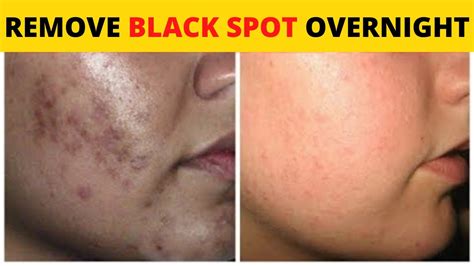 How To Get Rid Of Dark Spots On Your Face Overnight How To Get Rid Of
