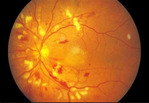 hypertensive retinopathy symptoms stages treatment