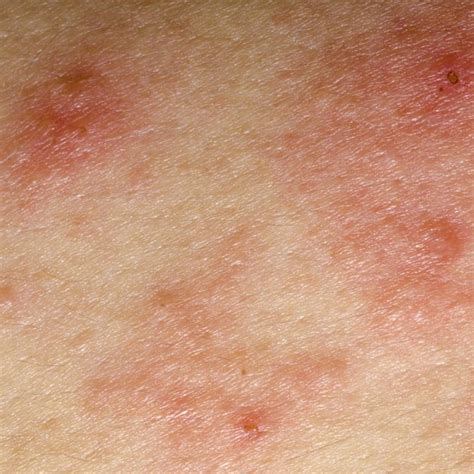 Diseases That Cause Eczema