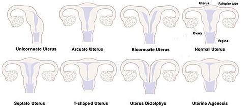 Schematic Diagrams Of Uterine Congenital Malformations According To The