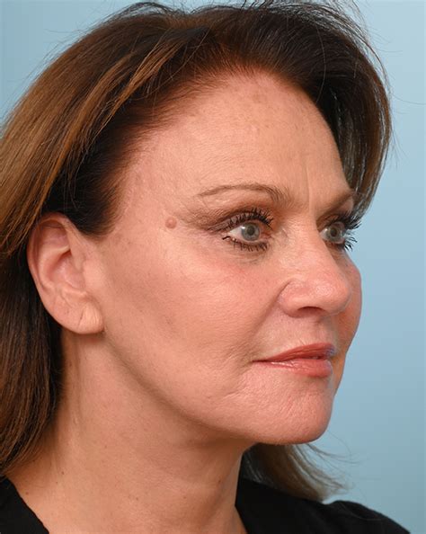 Del Mar Facial Fat Transfer Before And After Photos San Diego Plastic