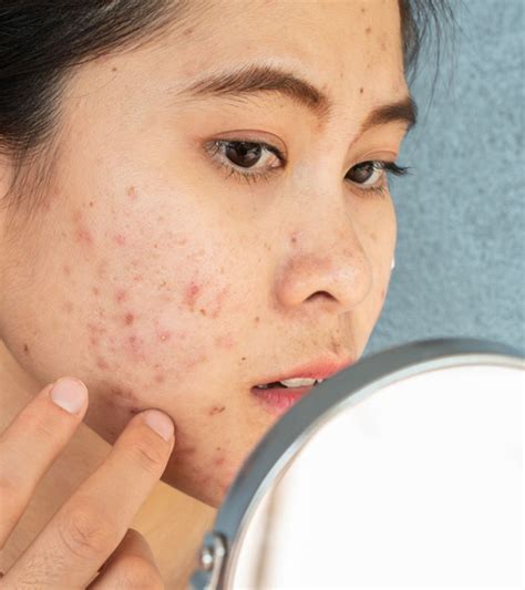 Fungal Acne Symptoms Causes And Treatment Options