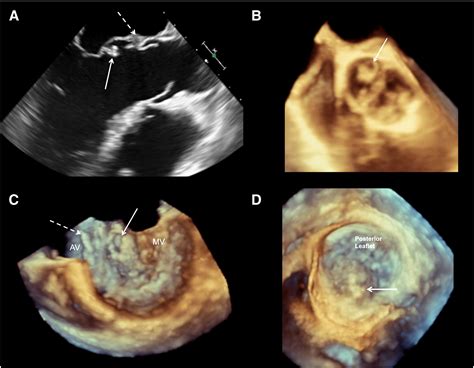 Comprehensive Assessment Of Complications Of Infective Endocarditis By