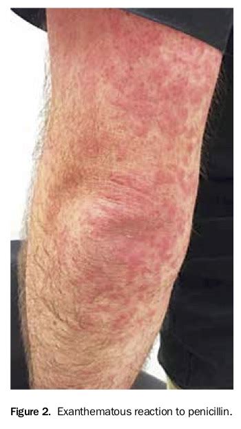 A Rash On The Forearms Of A Hospitalised Patient Medicine Today