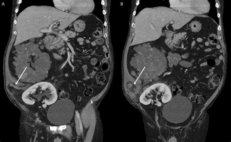 Ct Abdomen And Pelvis With Intravenous Contrast Administration