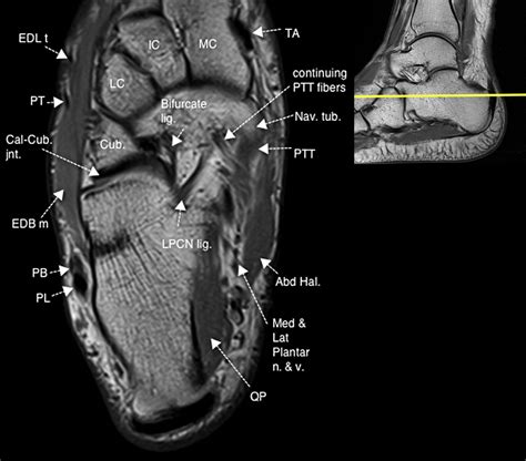 These muscles act to produce the fine movements of the toes and they also just before i start, just a quick mention about the innervation of the foot muscles. Normal Magnetic Resonance Imaging Anatomy of the Ankle & Foot - Magnetic Resonance Imaging Clinics