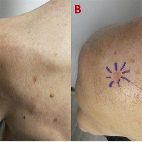 Histologic Features Of Atrophic Dermatofibroma On The Left Shoulder Of Download Scientific