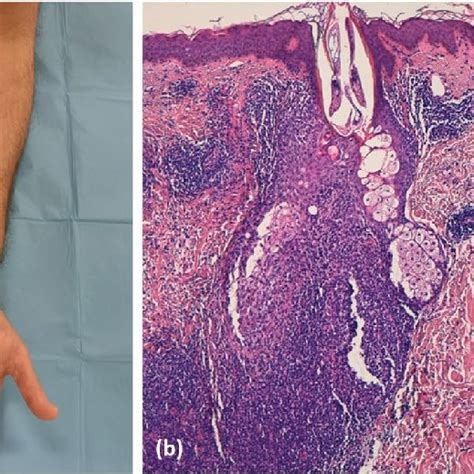 Palpable Purpura Consistent With Cutaneous Leukocytoclastic Vasculitis
