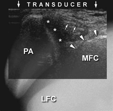 Medial Plica Syndrome Of The Knee Diagnosis With Dynamic Sonography