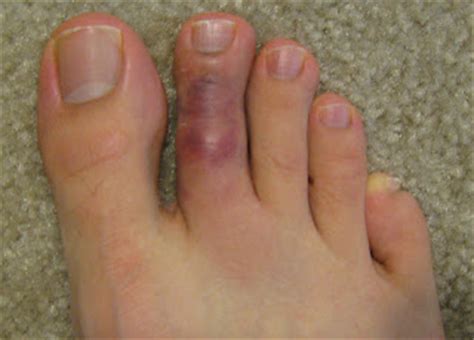 What should i do if i break my finger? VittoriFootAnkleSpecialist: How to Tell if You have a ...