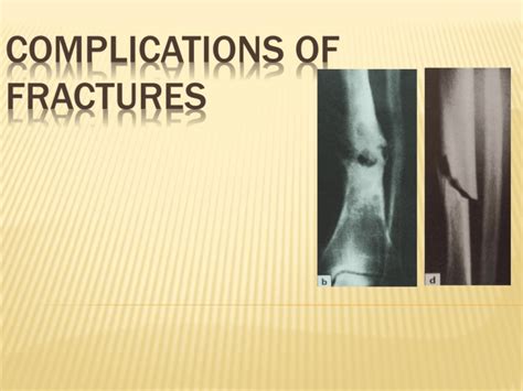 Complications Of Fractures Ppt