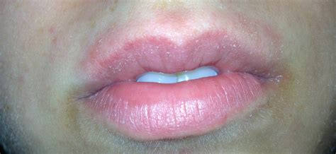 Lip swelling can be cause for concern since it often implicates an allergic reaction. Monica LOVES Makeup: Lip Product Allergic Reaction - Again?!