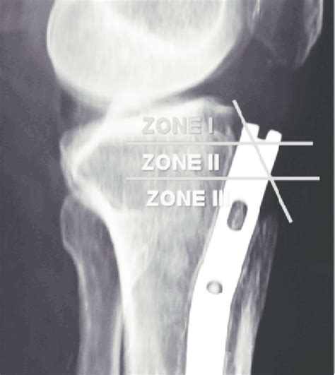 Lateral Radiograph Showing Division Of Proximal Tibia Into Three Zones