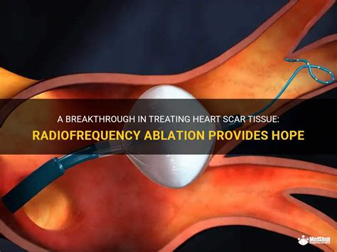 A Breakthrough In Treating Heart Scar Tissue Radiofrequency Ablation