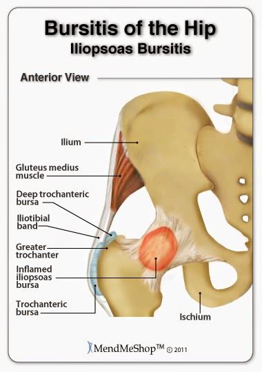 Pain Free Physiotherapy Clinicbloggers Bursitis And Tendinitis Around Hip