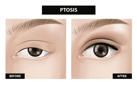 What Causes Ptosis And How Is It Corrected Rand Rodgers Md