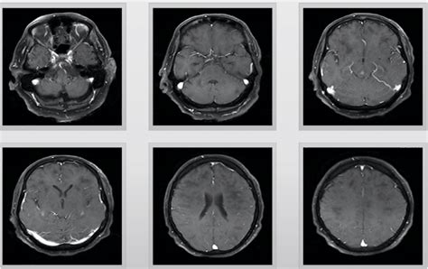 T1 Postcontrast Gadolinium Views Axial Magnetic Resonance Imaging